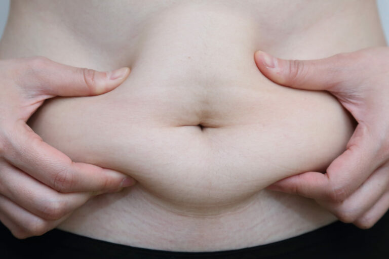 Quel est l’intérêt de l’abdominoplastie chez un patient obèse ?