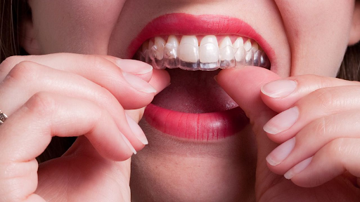 Comment les aligneurs dentaires, peuvent vous offrir le sourire de vos rêves