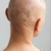 Repousse cheveux après alopécie