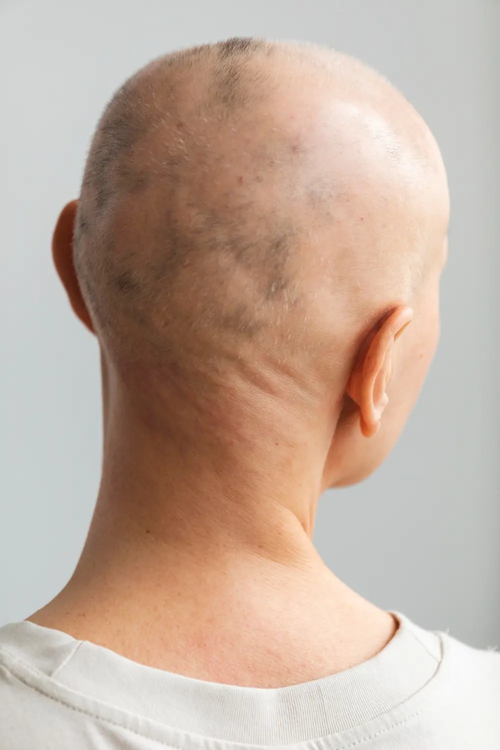 Repousse cheveux après alopécie